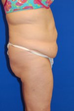 Tummy Tuck