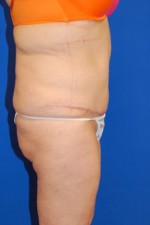 Tummy Tuck