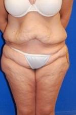 Tummy Tuck