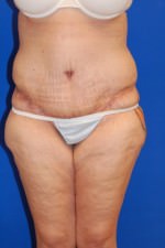 Tummy Tuck