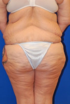 Tummy Tuck