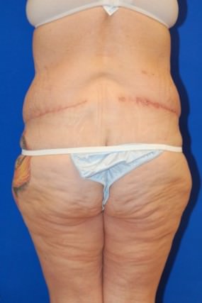 Tummy Tuck