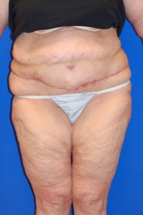 Tummy Tuck