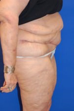 Tummy Tuck