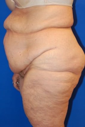 Tummy Tuck