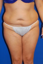 Tummy Tuck