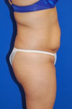 Tummy Tuck