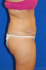 Tummy Tuck