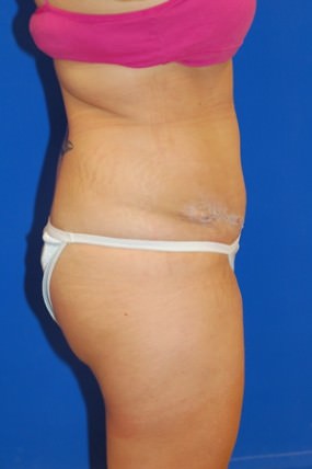 Tummy Tuck