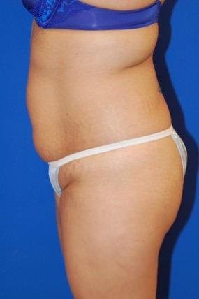 Tummy Tuck