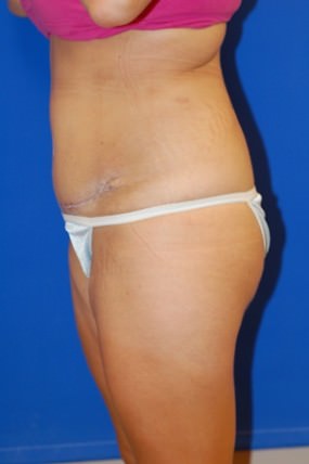 Tummy Tuck