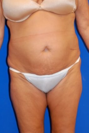Tummy Tuck