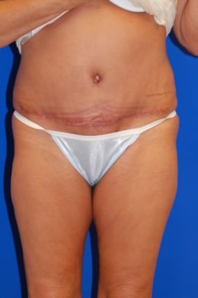 Tummy Tuck