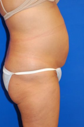Tummy Tuck