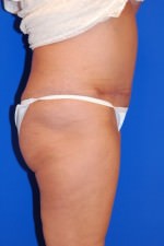 Tummy Tuck