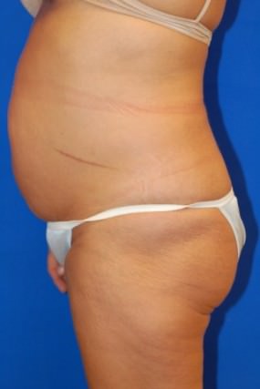 Tummy Tuck