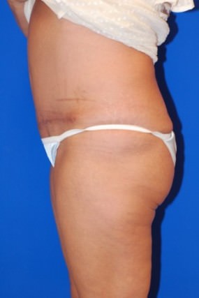 Tummy Tuck