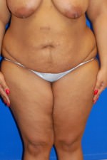 Tummy Tuck