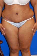 Tummy Tuck