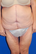 Tummy Tuck