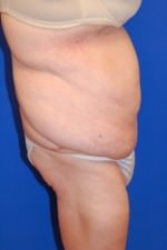 Tummy Tuck