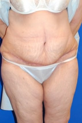 Tummy Tuck