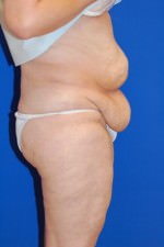 Tummy Tuck