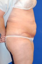 Tummy Tuck