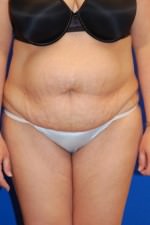 Tummy Tuck