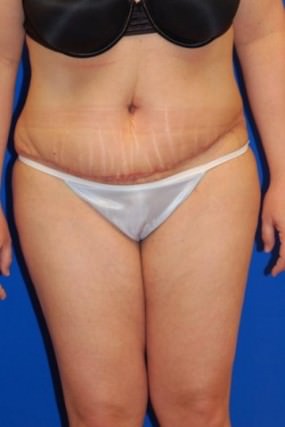 Tummy Tuck