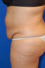 Tummy Tuck