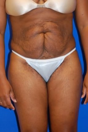 Tummy Tuck