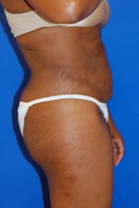 Tummy Tuck