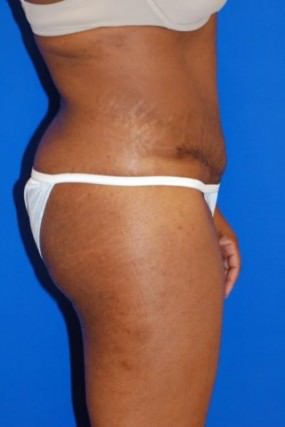 Tummy Tuck