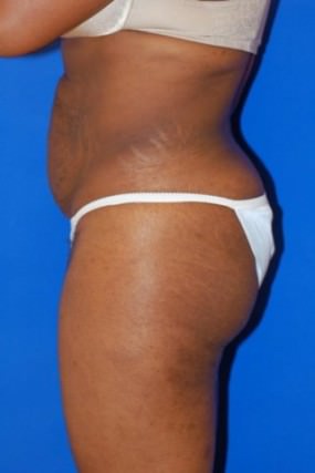 Tummy Tuck