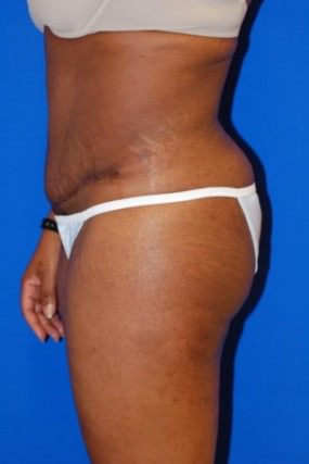 Tummy Tuck