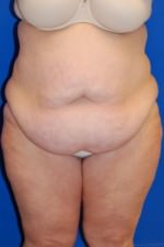 Tummy Tuck