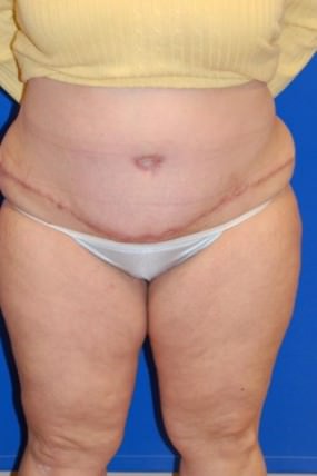 Tummy Tuck