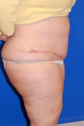 Tummy Tuck