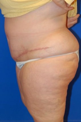 Tummy Tuck
