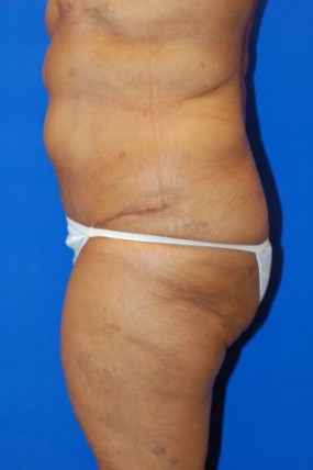 Tummy Tuck Case 3568 Tummy Tuck After Photo Tummy Tuck