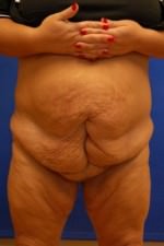 Tummy Tuck