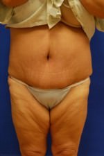 Tummy Tuck