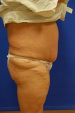 Tummy Tuck