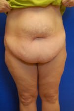 Tummy Tuck