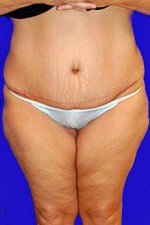 Tummy Tuck