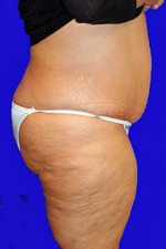 Tummy Tuck