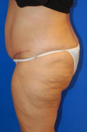 Tummy Tuck Case 3589 Tummy Tuck After Photo Tummy Tuck