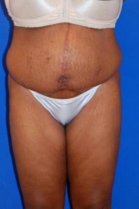 Tummy Tuck Case 3596 Tummy Tuck After Photo Tummy Tuck