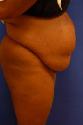 Tummy Tuck Case 3596 Tummy Tuck Before Photo Tummy Tuck